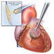 Illustration for article titled This worm-inspired glue can mend broken hearts